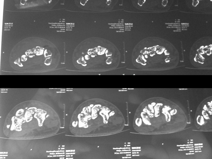 腕关节ct