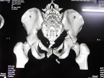 35岁男性复杂骨盆骨折的治疗