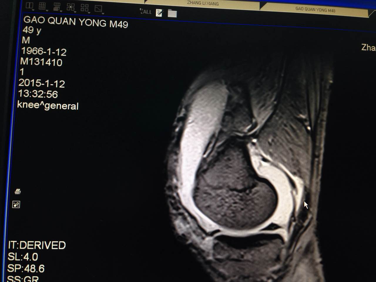 男49,膝关节结核,唯医,allinmd