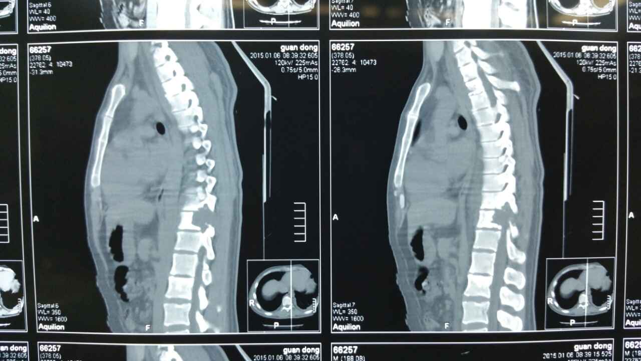 男28,胸椎结核的处理