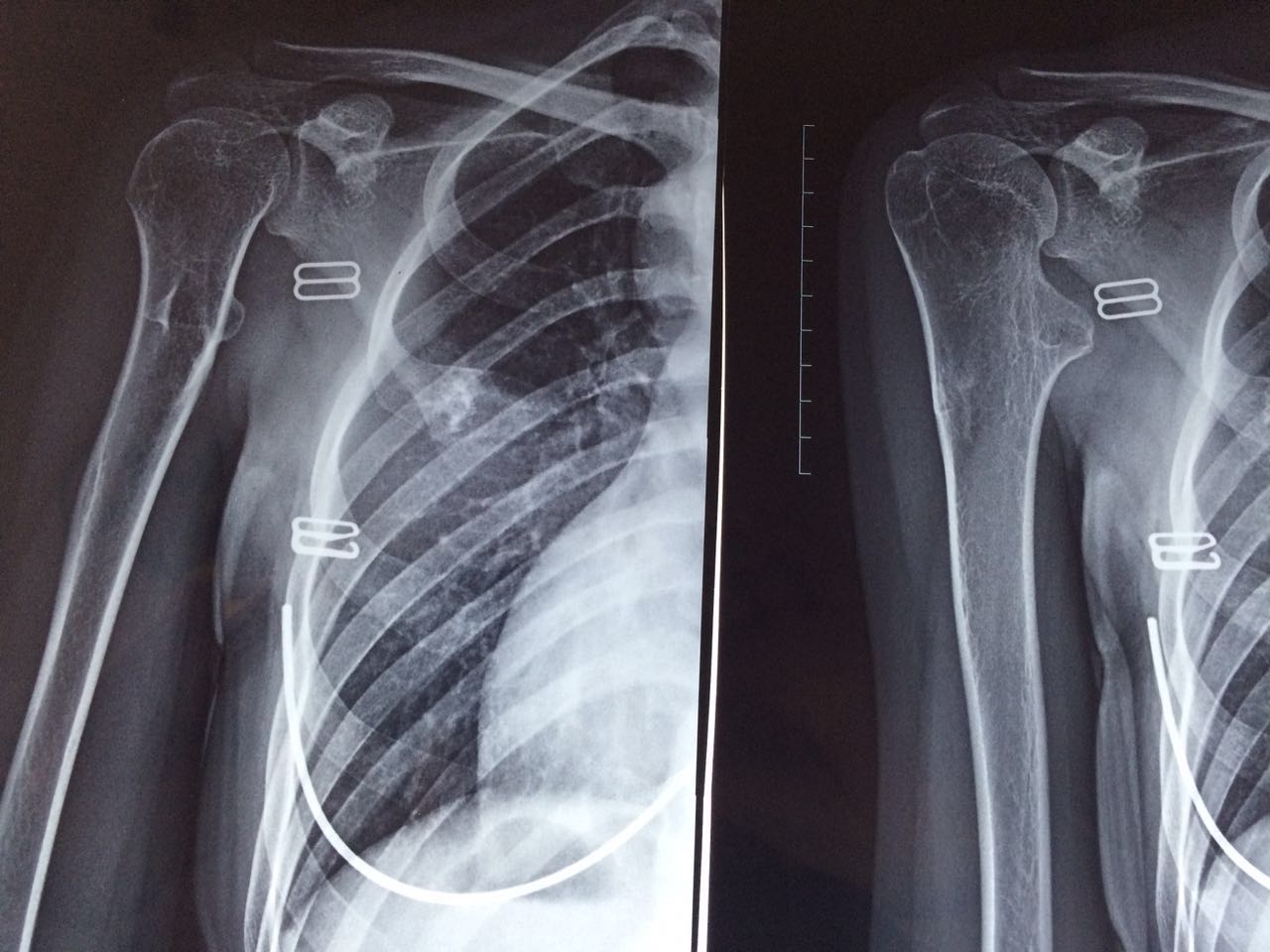 图3-26 正常肩关节(正位×线像)-外科学-医学