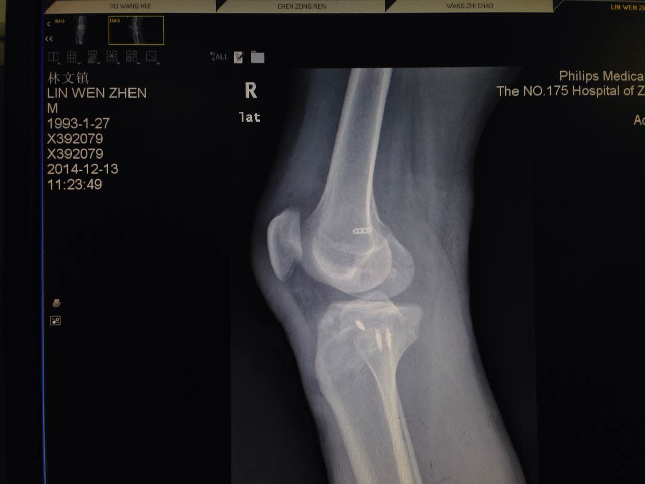 左膝盖髌骨骨折图片,右髌骨骨折图片,髌骨骨折图片_大山谷图库