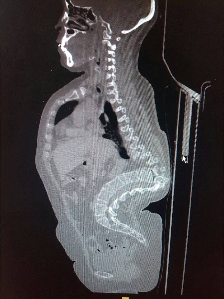 女55,胸腰椎畸形