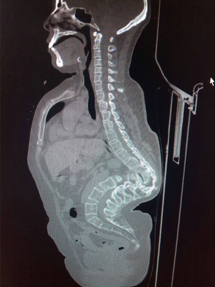 女55,胸腰椎畸形