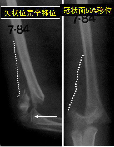 小儿肱骨髁上骨折