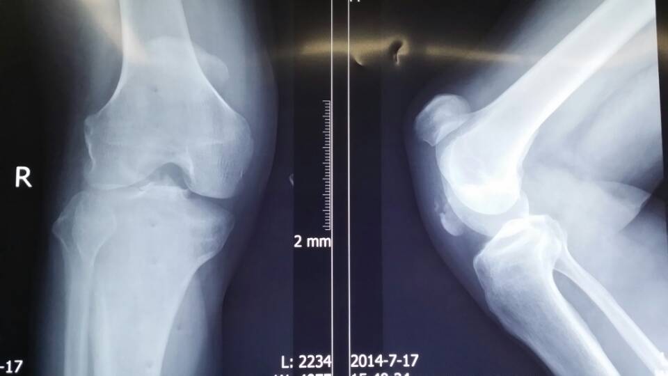 男57岁,髌骨陈旧性骨折