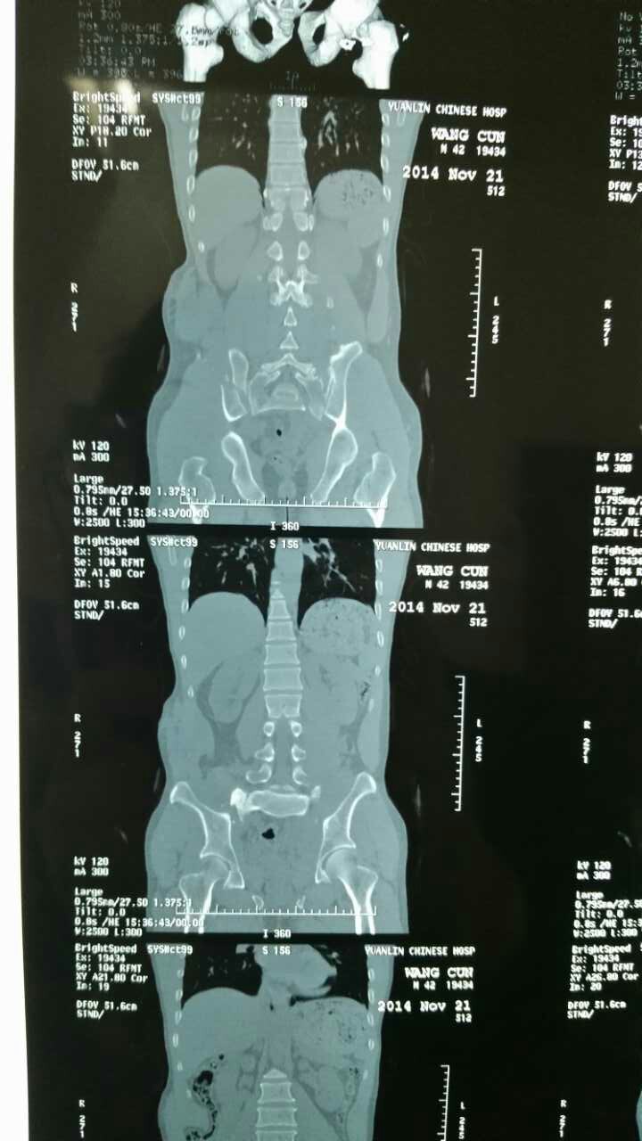 男45岁,骨盆骨折