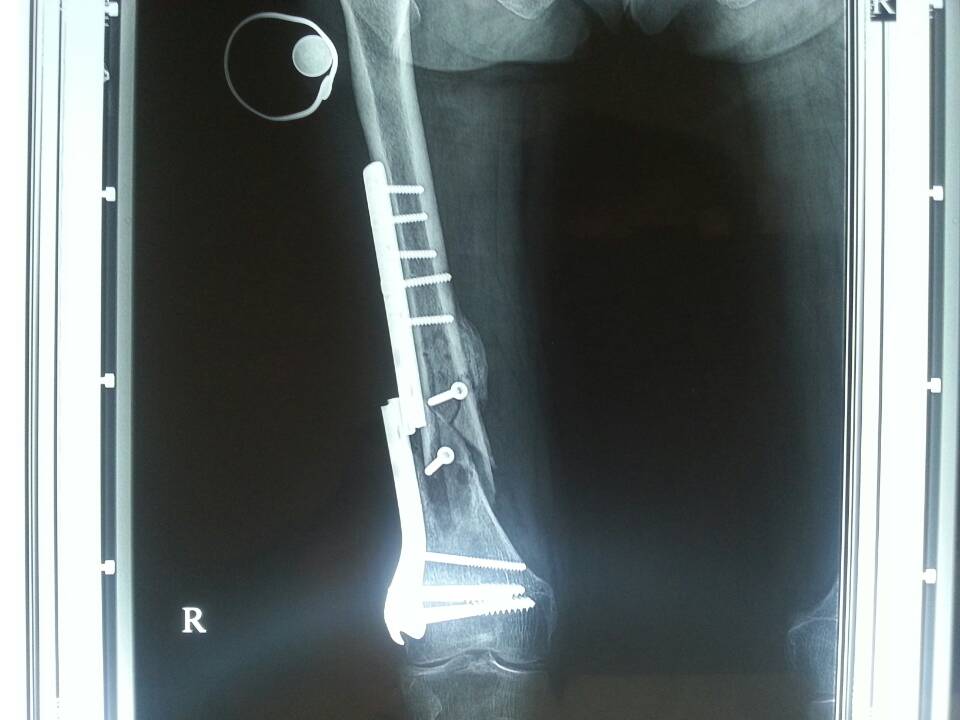 女64岁,股骨骨折内固定术后钢板断裂