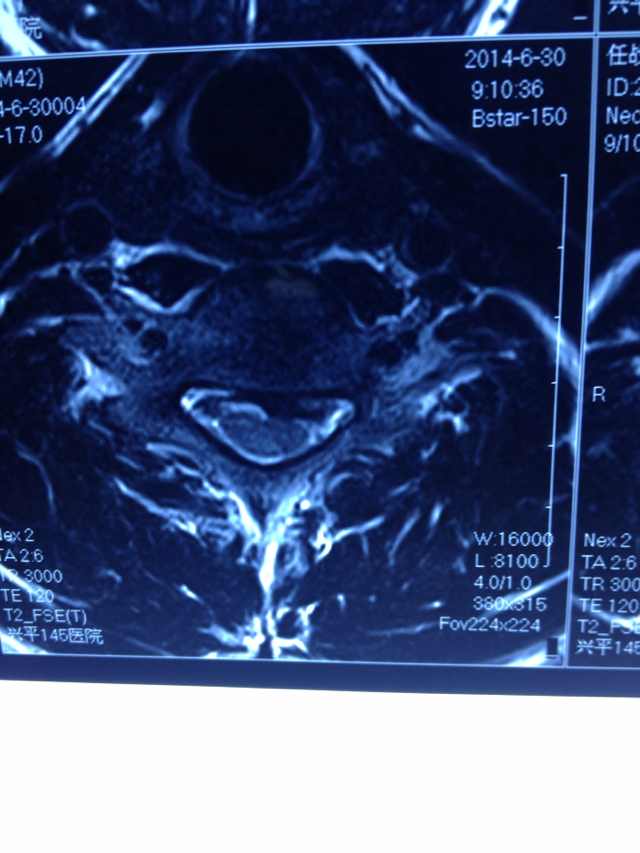 男42,颈椎间盘突出?