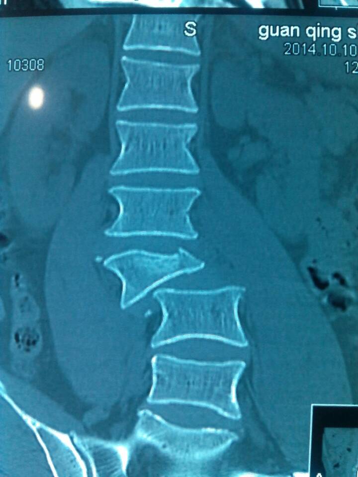 男45,l3椎体爆裂骨折并l2,3,l3,4脱位