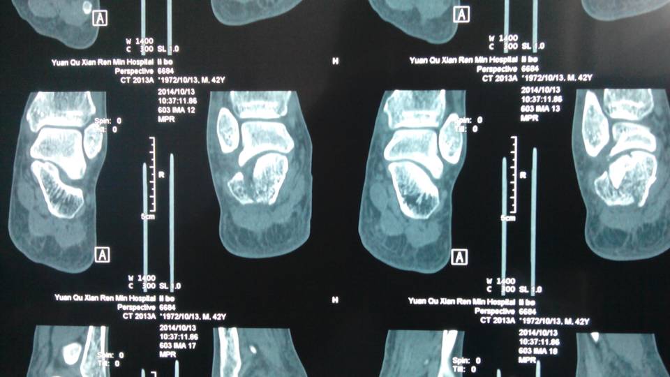 跟骨ct