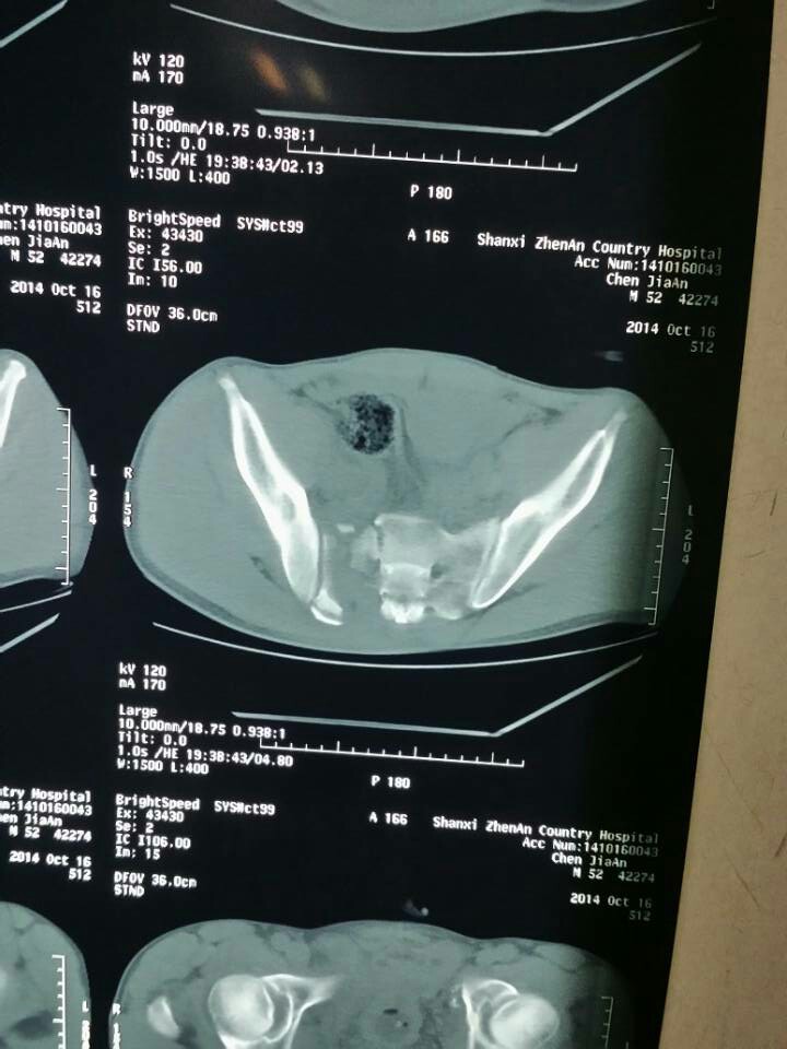 男52岁,骨盆骨折