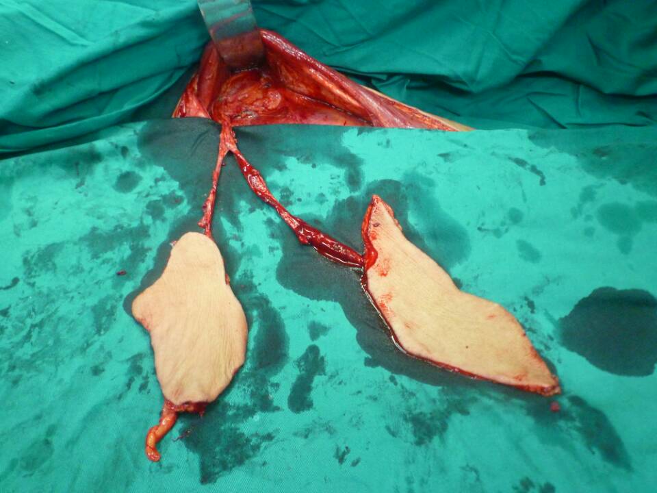 图华 手足外科群(chizhenglin):足背部的皮瓣移置