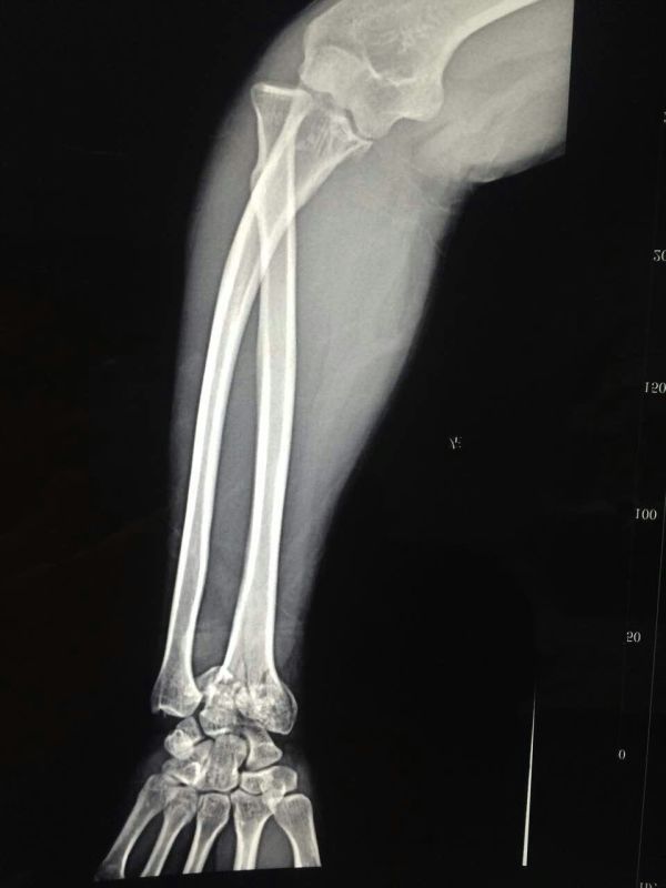 男33岁 腰摔伤了怎么办 我一年前手腕摔伤,由于