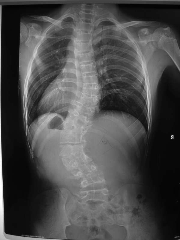 斐14岁男孩先天性脊柱侧弯术后存在严重侧后凸畸形