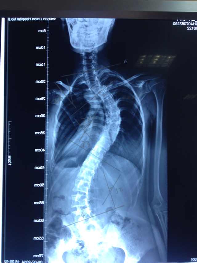 斐16岁女孩脊柱侧弯畸形,是否适合做选择性融合