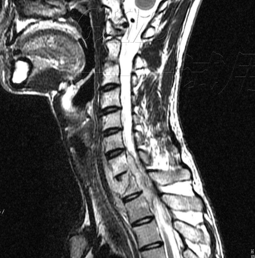 男,24岁,颈胸段结核并椎旁脓肿