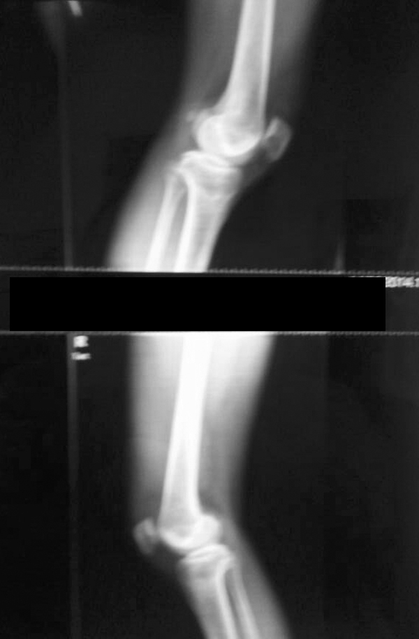 男78岁,股骨内髁骨折,胫骨平台骨折