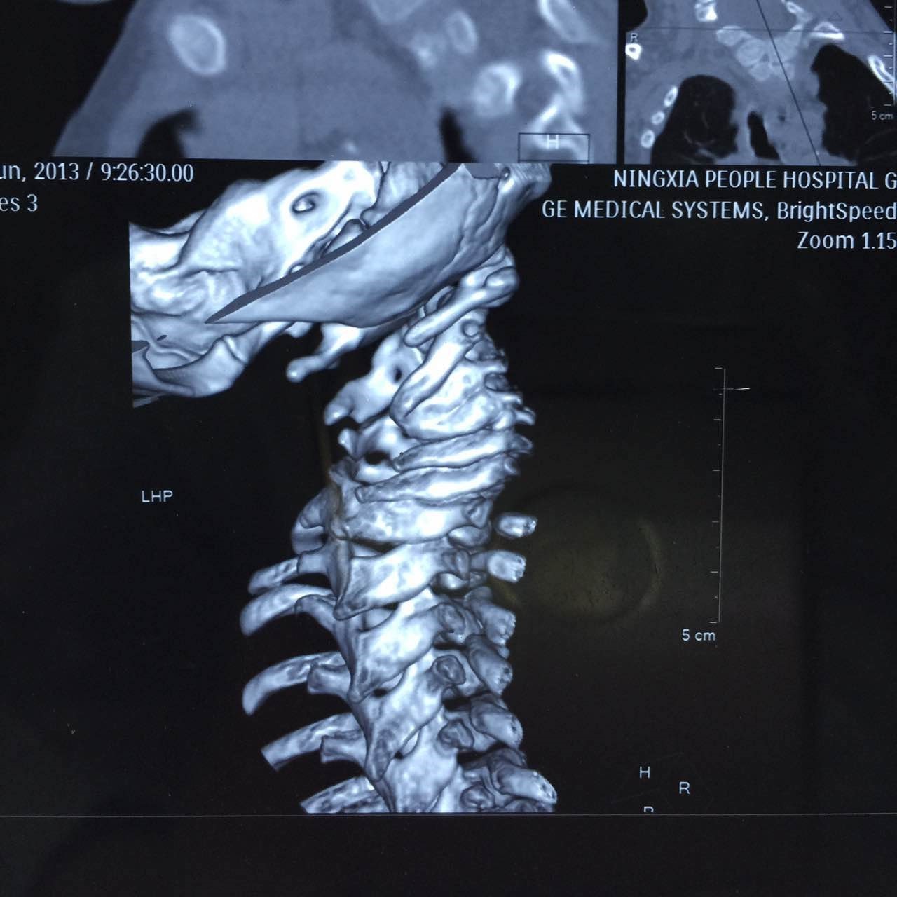 患儿4岁10月,先天性颈椎发育不良及骨性斜颈