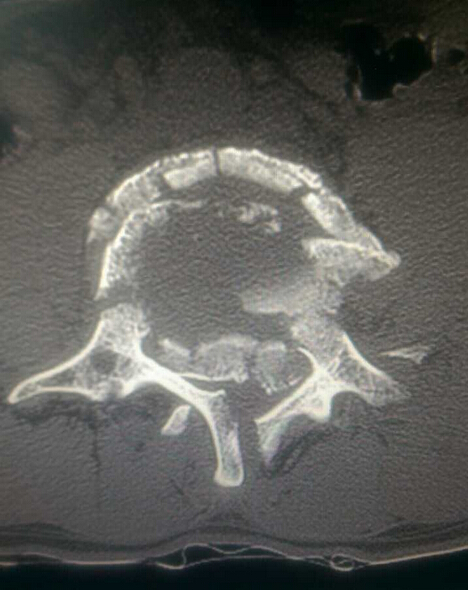 腰4椎体爆裂性骨折并腰5椎体峡部裂