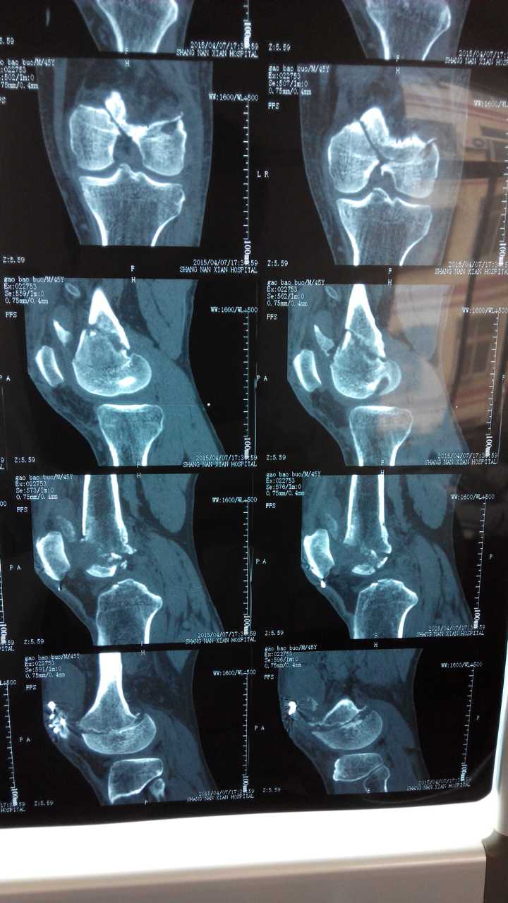 男51岁,髋臼骨折及股骨髁骨折