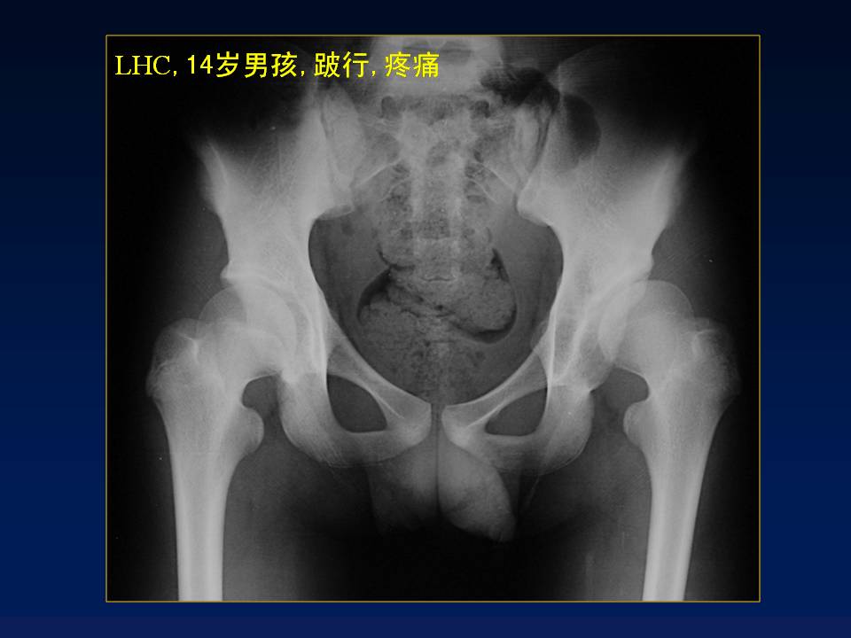 chiari截骨术治疗大龄ddh