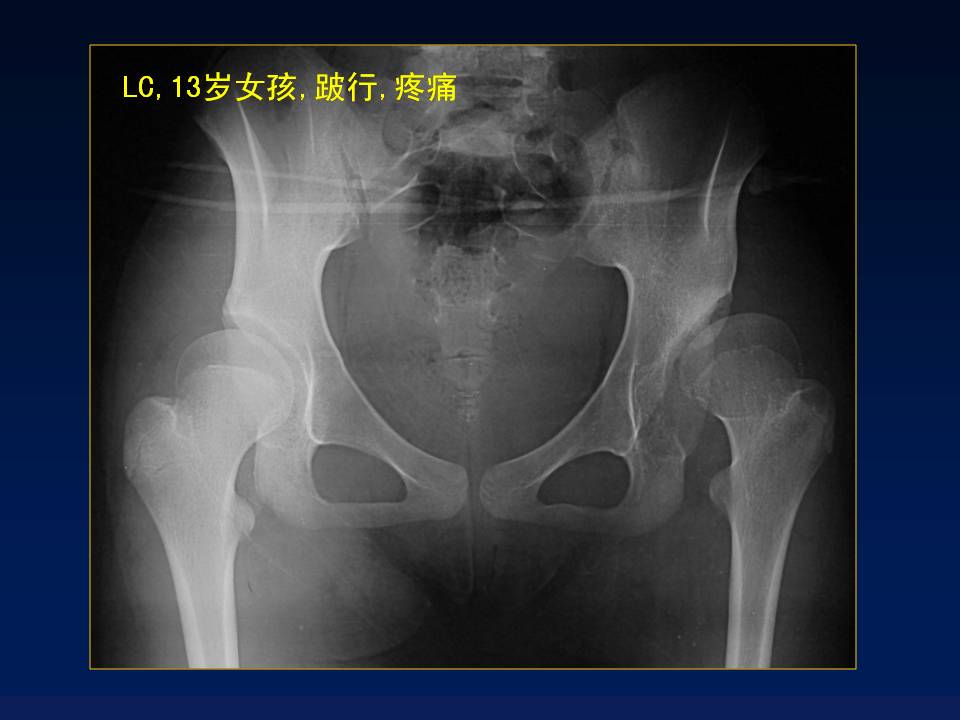 chiari截骨术治疗大龄ddh