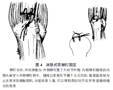 另一种"床垫式双铆钉固定(mattress double anchor)"也可以增加肩袖