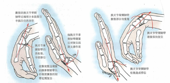 称为背侧barton骨折;桡骨远端掌侧关节缘骨折,伴有腕关节向掌侧脱位或