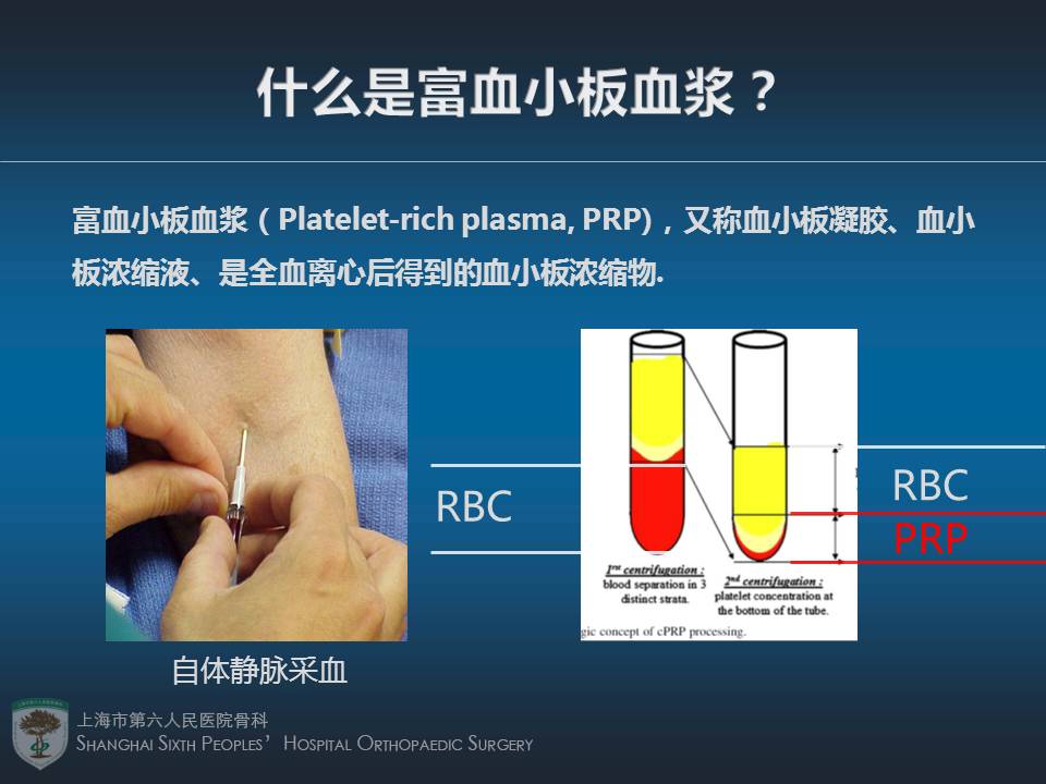 富血小板血浆plateletrichplasmaprp分离和临床应用