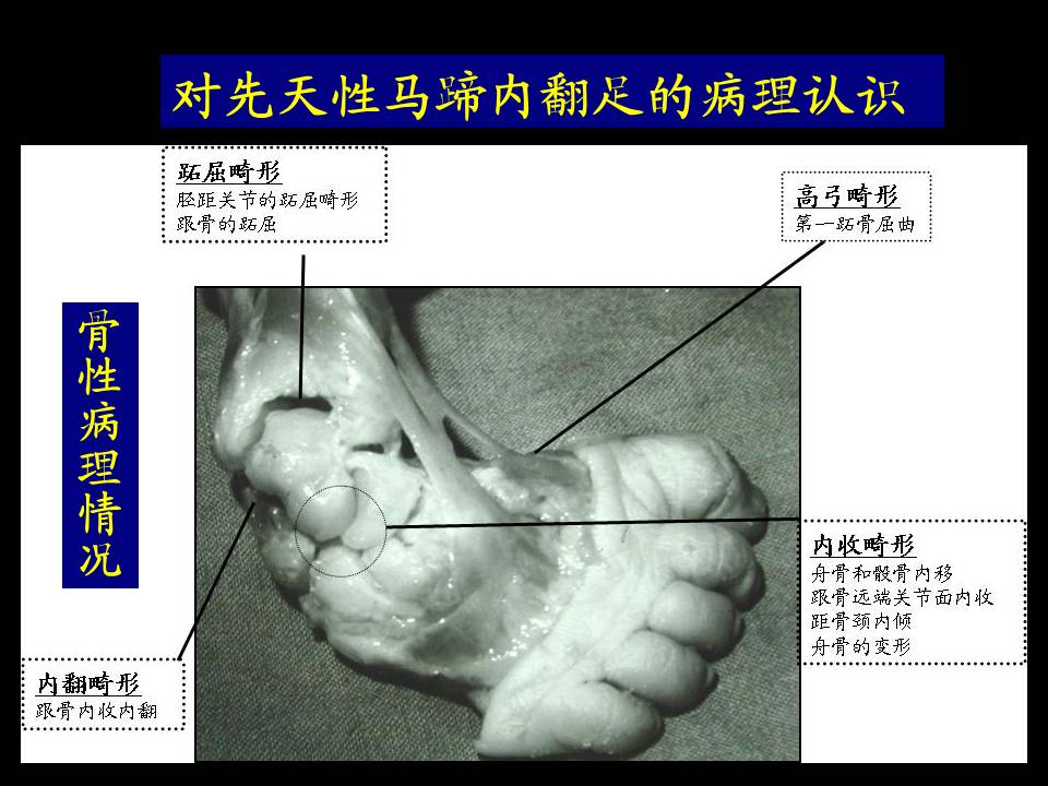 ponseti方法治疗先天性马蹄内翻足:细节决定不同