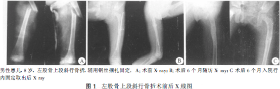 ender钉固定治疗小儿下肢长管状骨骨折
