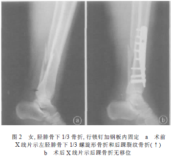 胫骨下13螺旋形骨折合并后踝骨折五例报告