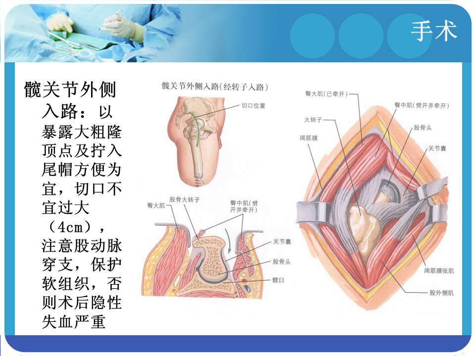 股骨粗隆间骨折治疗策略