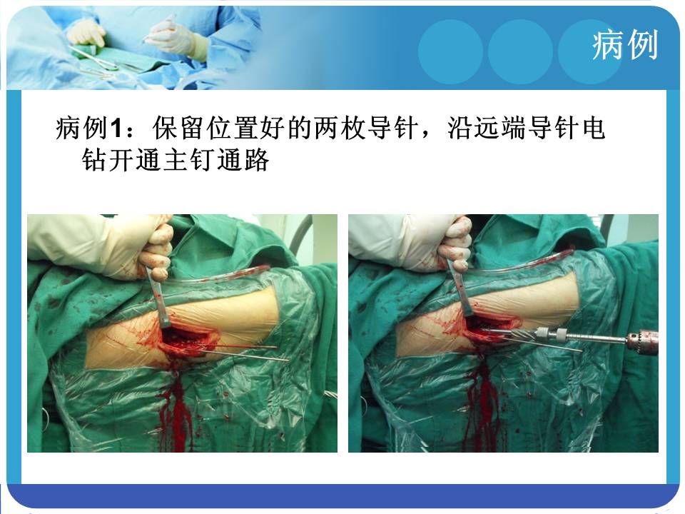 股骨粗隆间骨折治疗策略