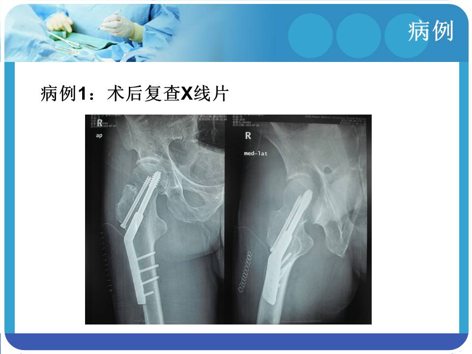 股骨粗隆间骨折治疗策略
