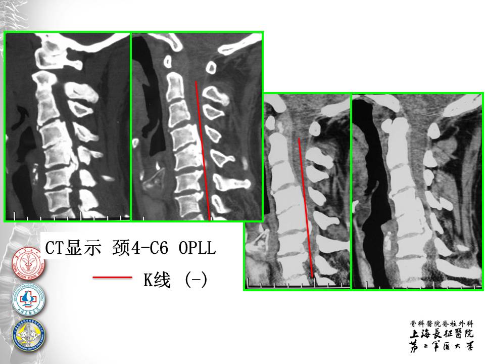 颈椎后纵韧带骨化症手术治疗策略