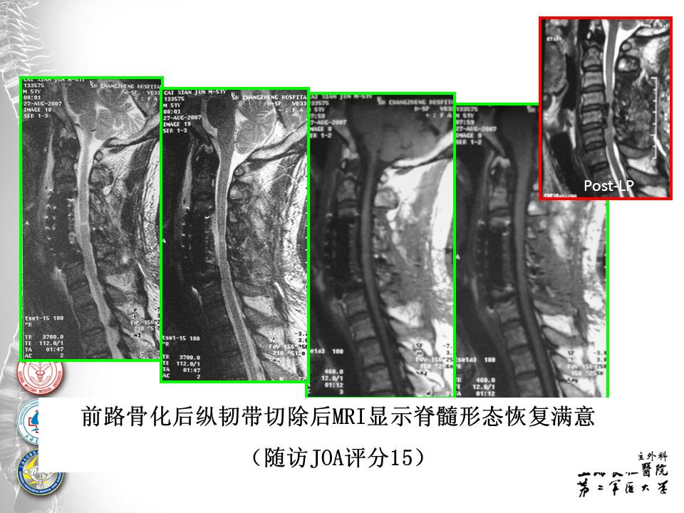 颈椎后纵韧带骨化症手术治疗策略