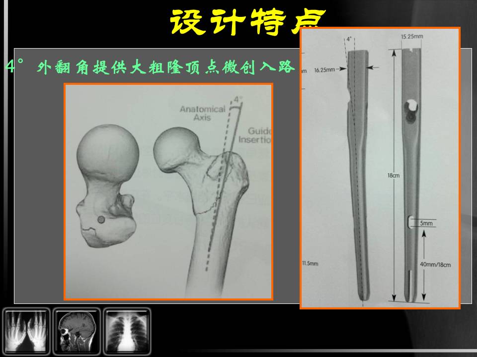 股骨粗隆间骨折的治疗