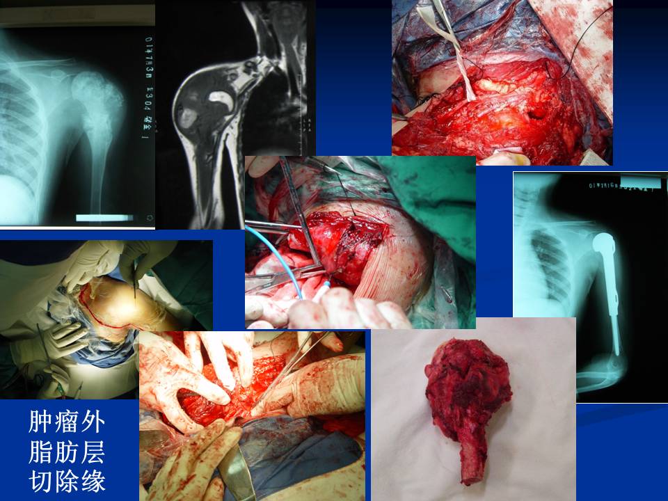 恶性骨肿瘤的切除原则及切除边界的评估