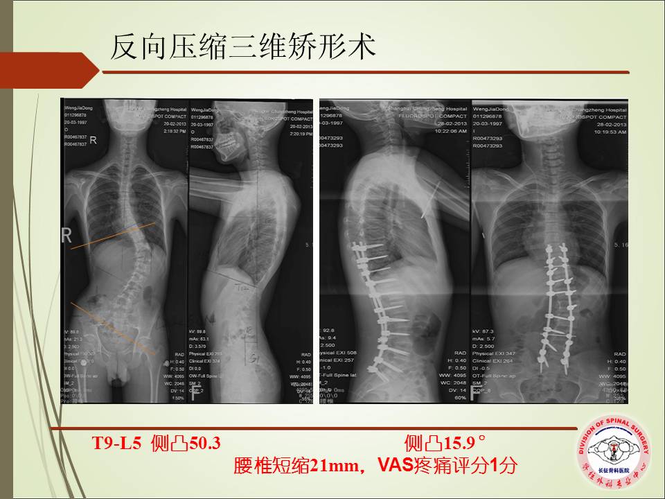 腰椎脊髓拴系综合征临床特点及外科治疗策略