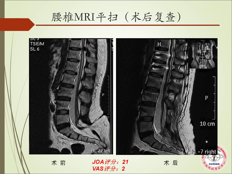 腰椎脊髓拴系综合征临床特点及外科治疗策略