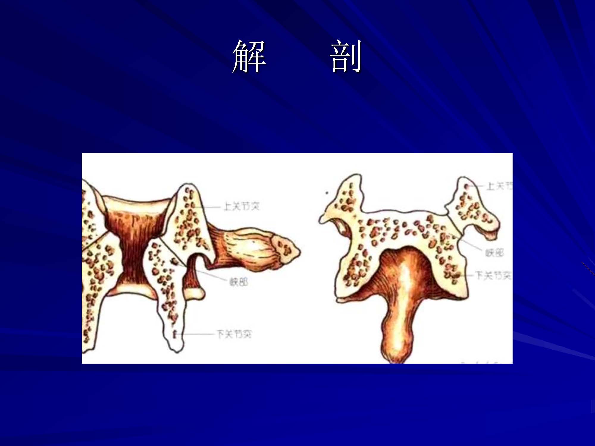 椎弓根螺丝钉,棘突钢丝系统治疗青年性腰椎椎弓峡部