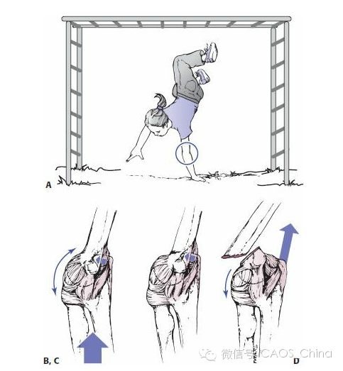 屈曲型肱骨髁上骨折