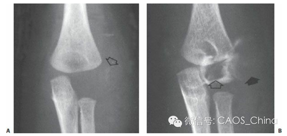 肱骨外髁骨化中心尚未出现 a:前后位.