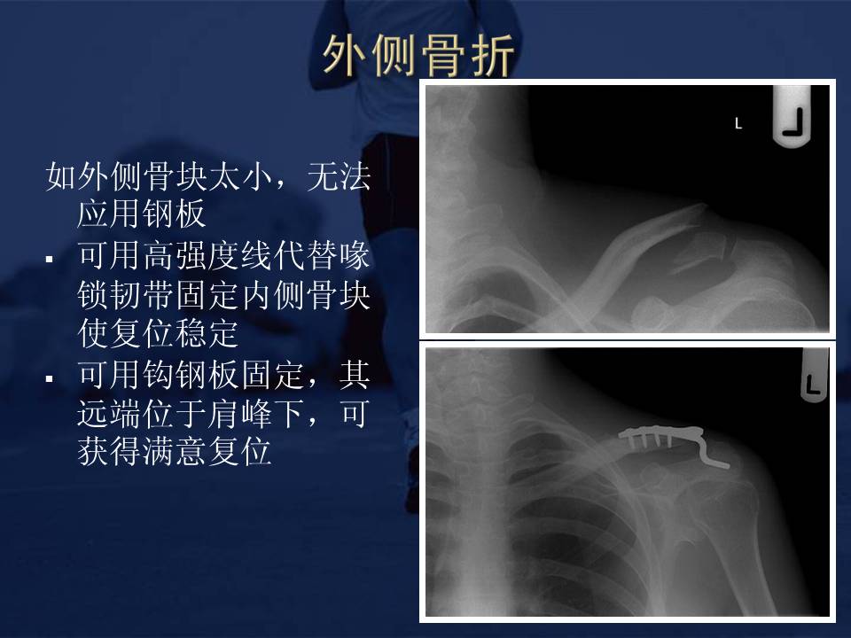 锁骨中段及远端骨折:非手术及手术治疗