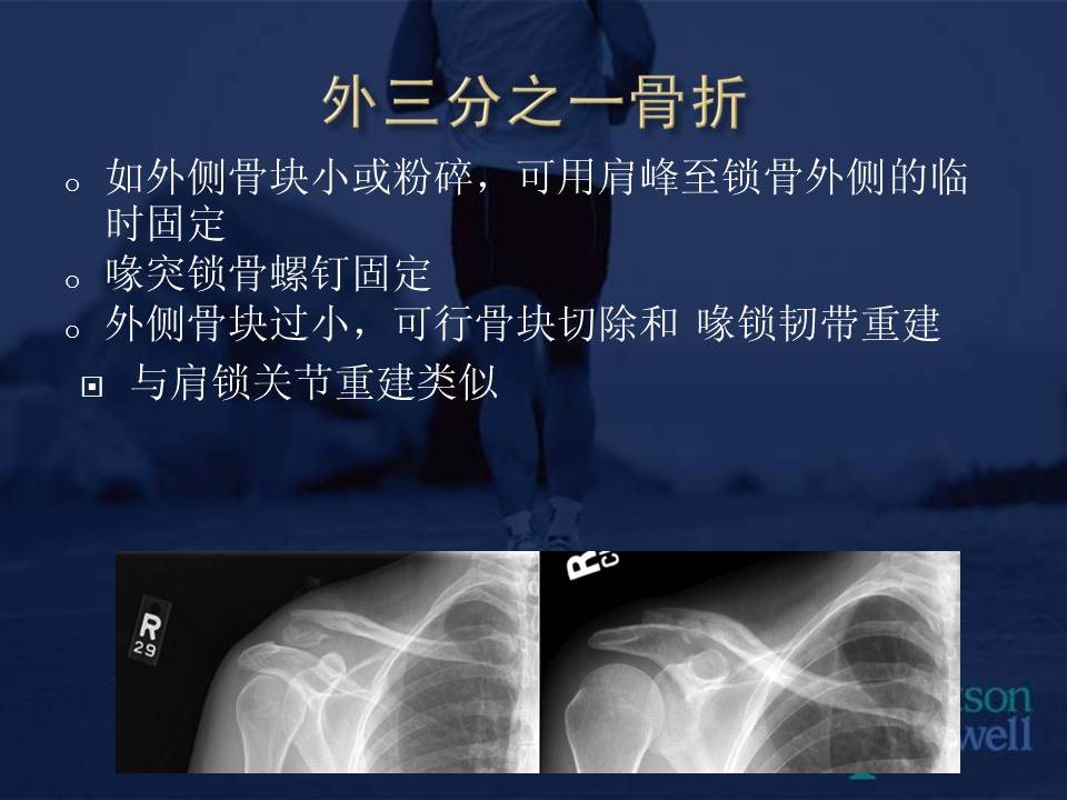 锁骨中段及远端骨折:非手术及手术治疗