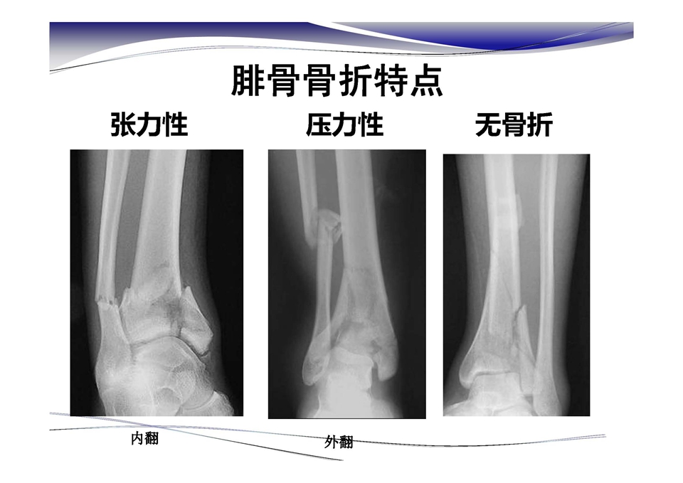 踝关节前侧入路--pilon骨折的治疗