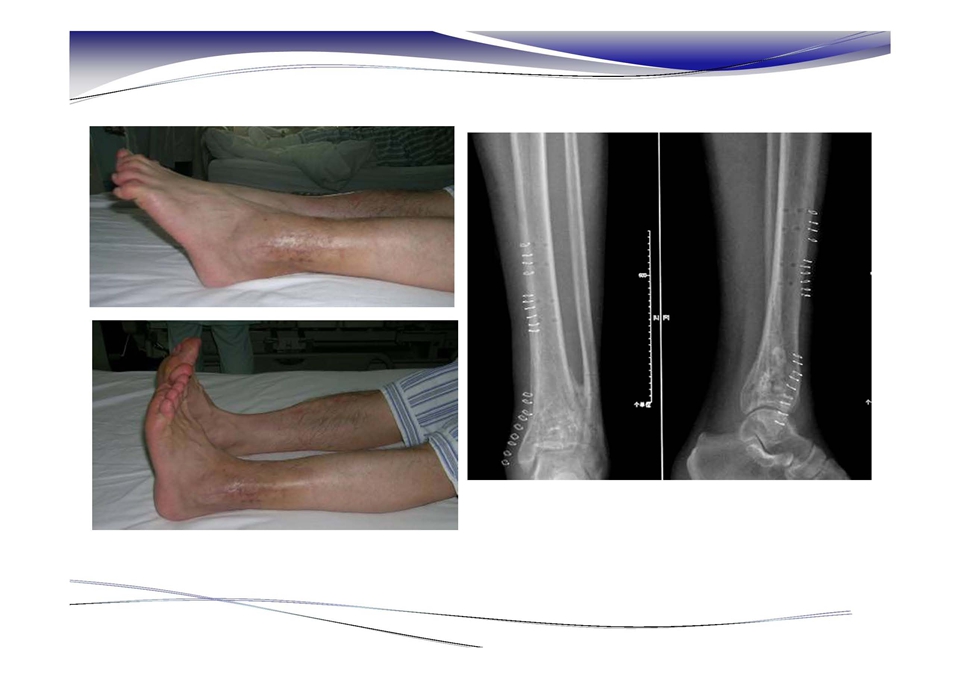 踝关节前侧入路--pilon骨折的治疗