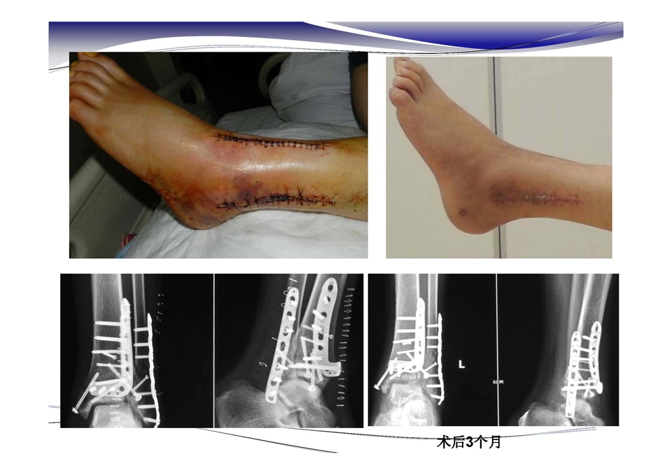 踝关节前侧入路--pilon骨折的治疗
